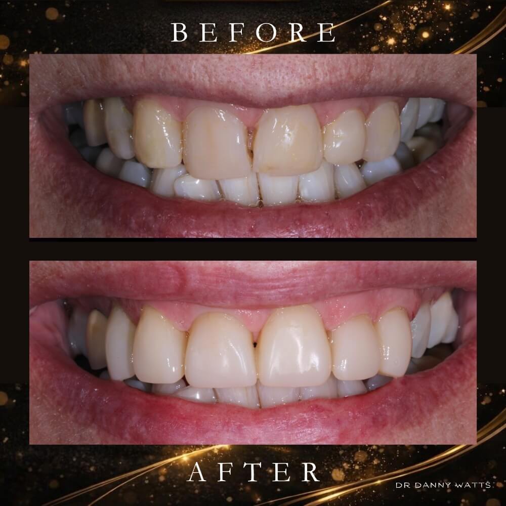 Before & After Results