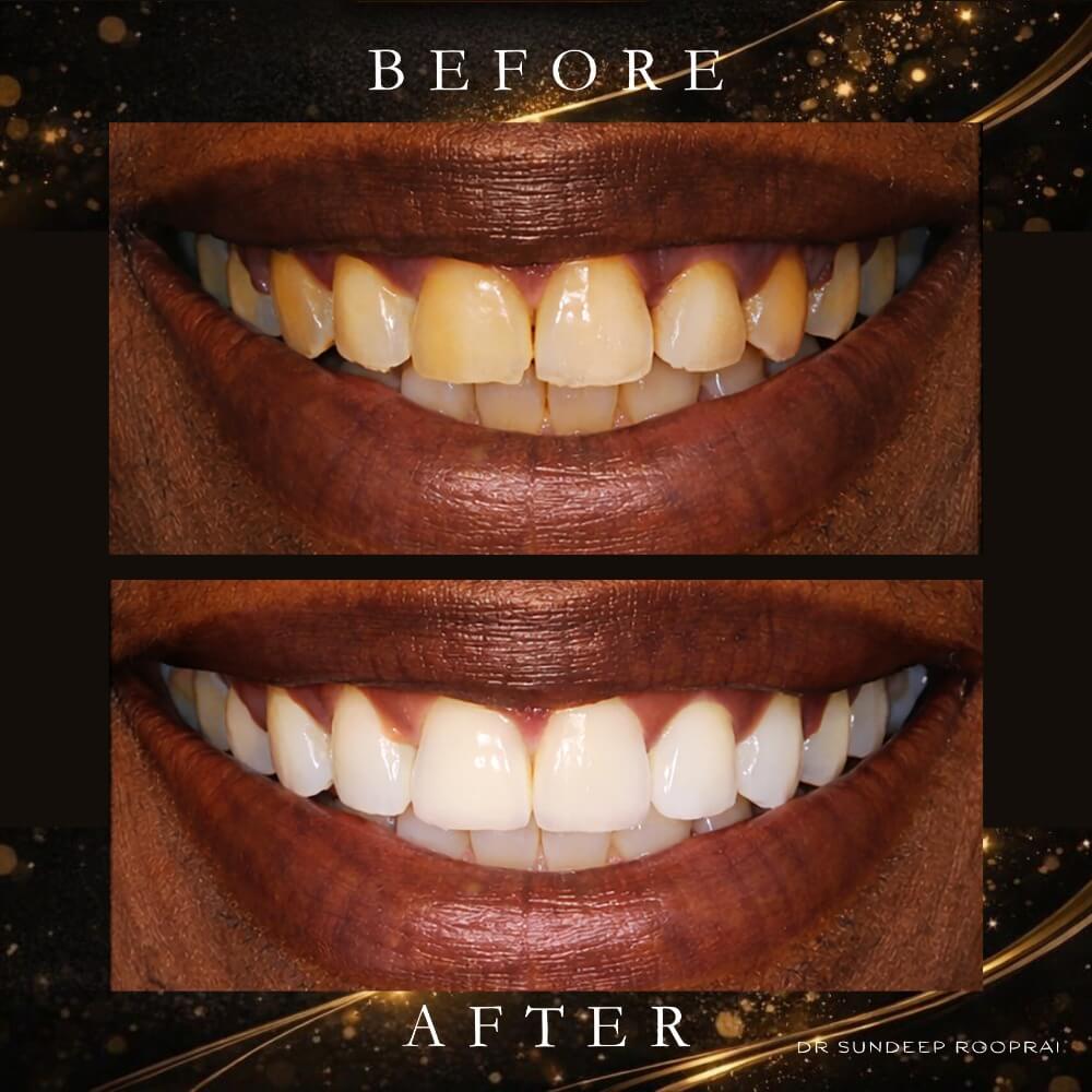 Before & After Results