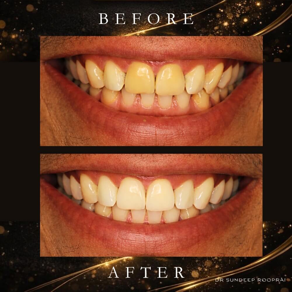 Before & After Results